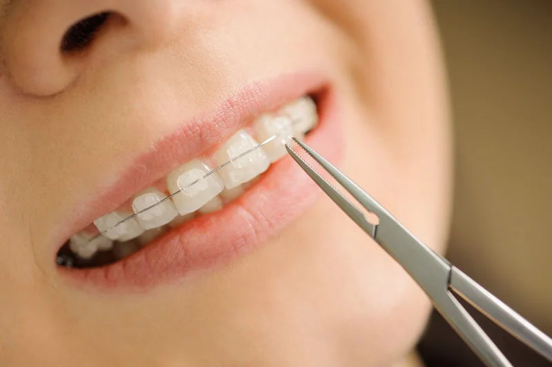Differences Between Invisalign vs. Ceramic Braces