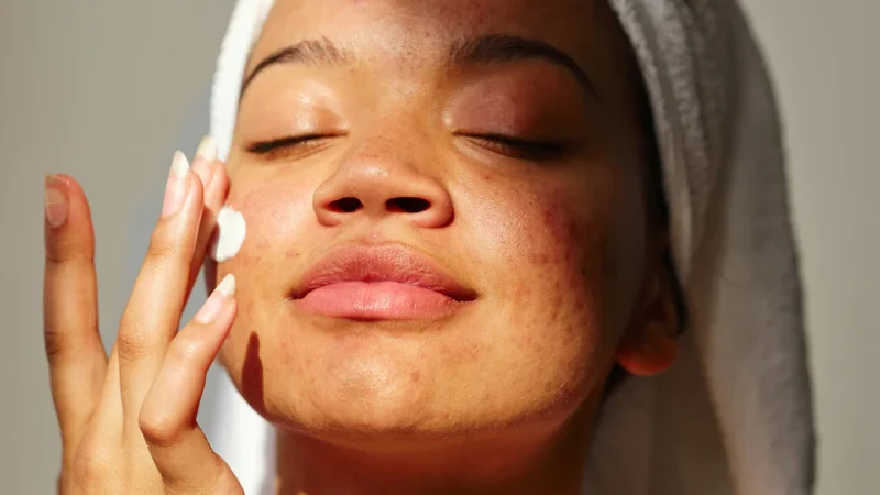 Soft, Healthy Skin with Nourishing Eczema Relief Methods